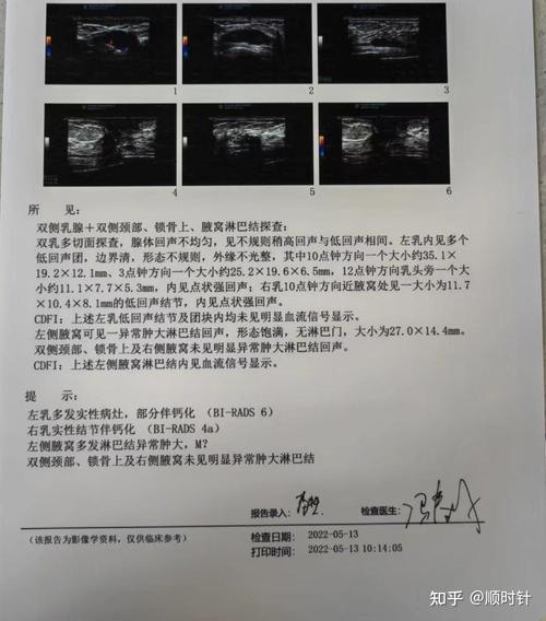 近5年乳腺癌研究有哪些新进展与突破?-图3 近5年乳腺癌研究有哪些新进展与突破?-图3