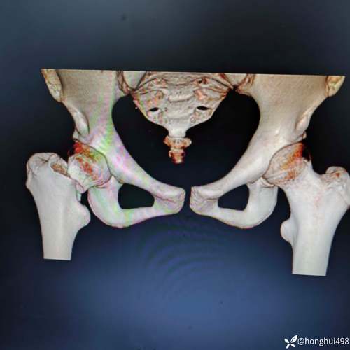 论文股骨颈骨折参考文献-图2