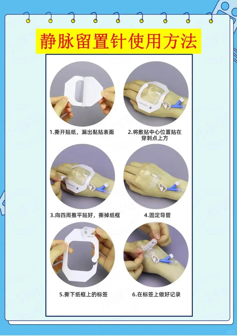 静脉留置针护理参考文献-图1