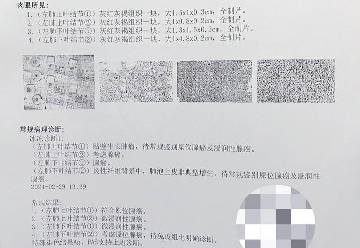 肺癌最新研究成果论文-图2